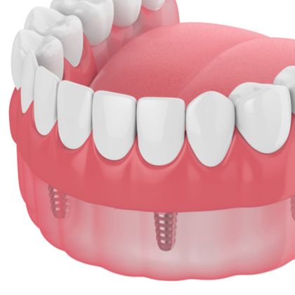 implant-supported denture